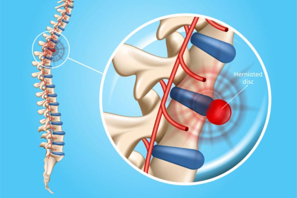 Hướng dẫn cách chọn nệm cho người thoát vị đĩa đệm 3 chứng thoát vị đĩa đệm