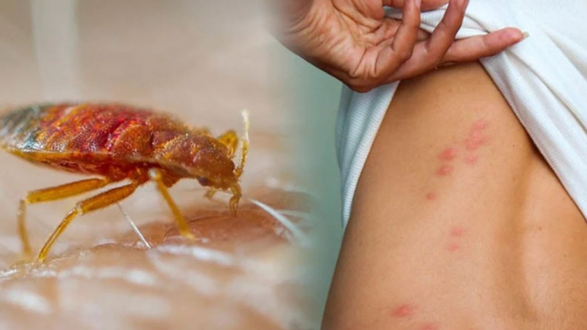 Bị rệp giường cắn bôi thuốc gì? Cách phòng chống rệp giường cắn